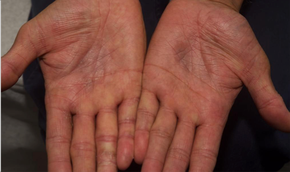 A close up of the same hands after 2 weeks of treatment with OPZELURA and a resulting IGA score of 1