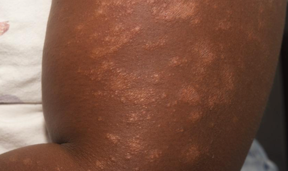 The arm of a dark-skinned person showing atopic dermatitis lesions before treatment that have an IGA score of 3