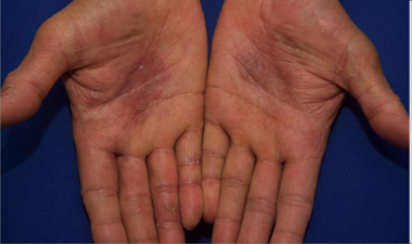 The palm side of hands with an atopic dermatitis lesions before treatment that have an IGA score of 3