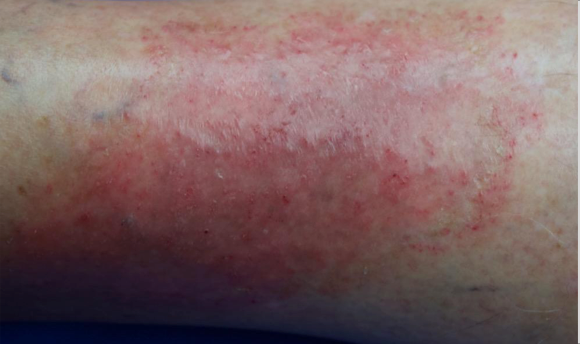 A close up of part of a lower leg showing an atopic dermatitis lesion before treatment that has an IGA score of 3
