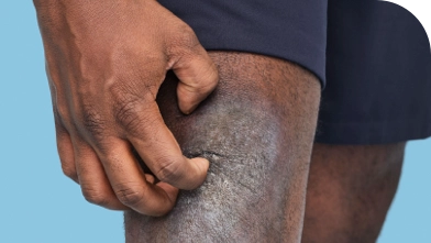 Patient experiencing redness and itching on the knee