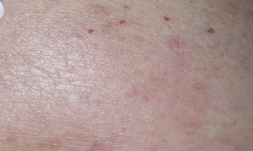 A close up and a zoomed out view of the same part of the back after 2 weeks of treatment with OPZELURA and a resulting IGA score of 1