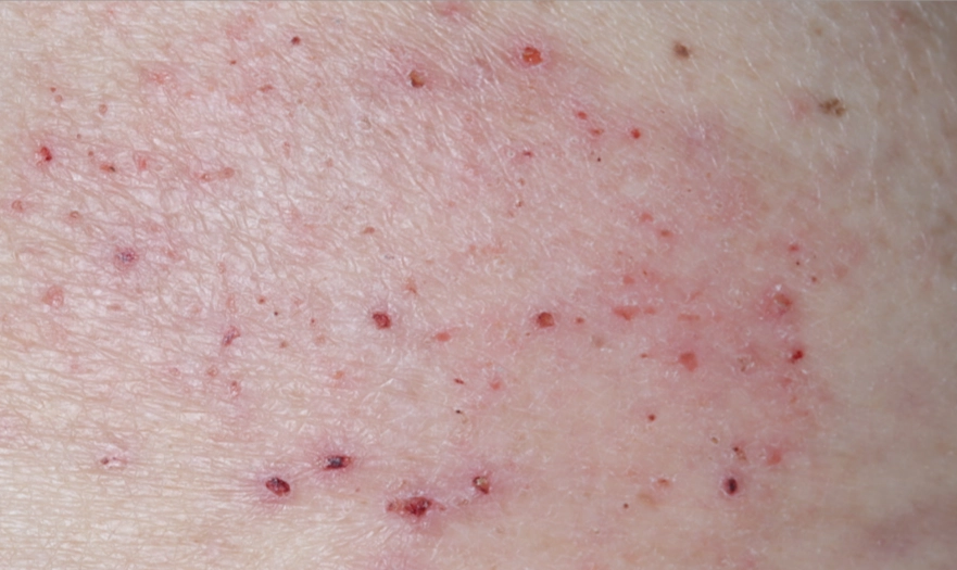 A close up of a part of a back and a zoomed out view of the back showing an atopic dermatitis lesion before treatment that has an IGA score of 3