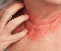 Patient experiencing redness and itching on the neck