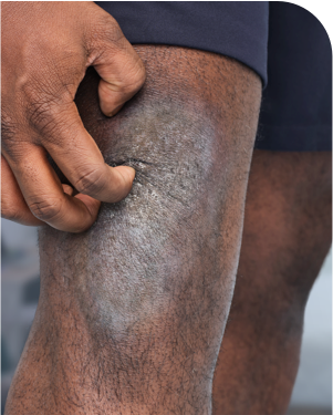 Patient experiencing redness and itching on the knee