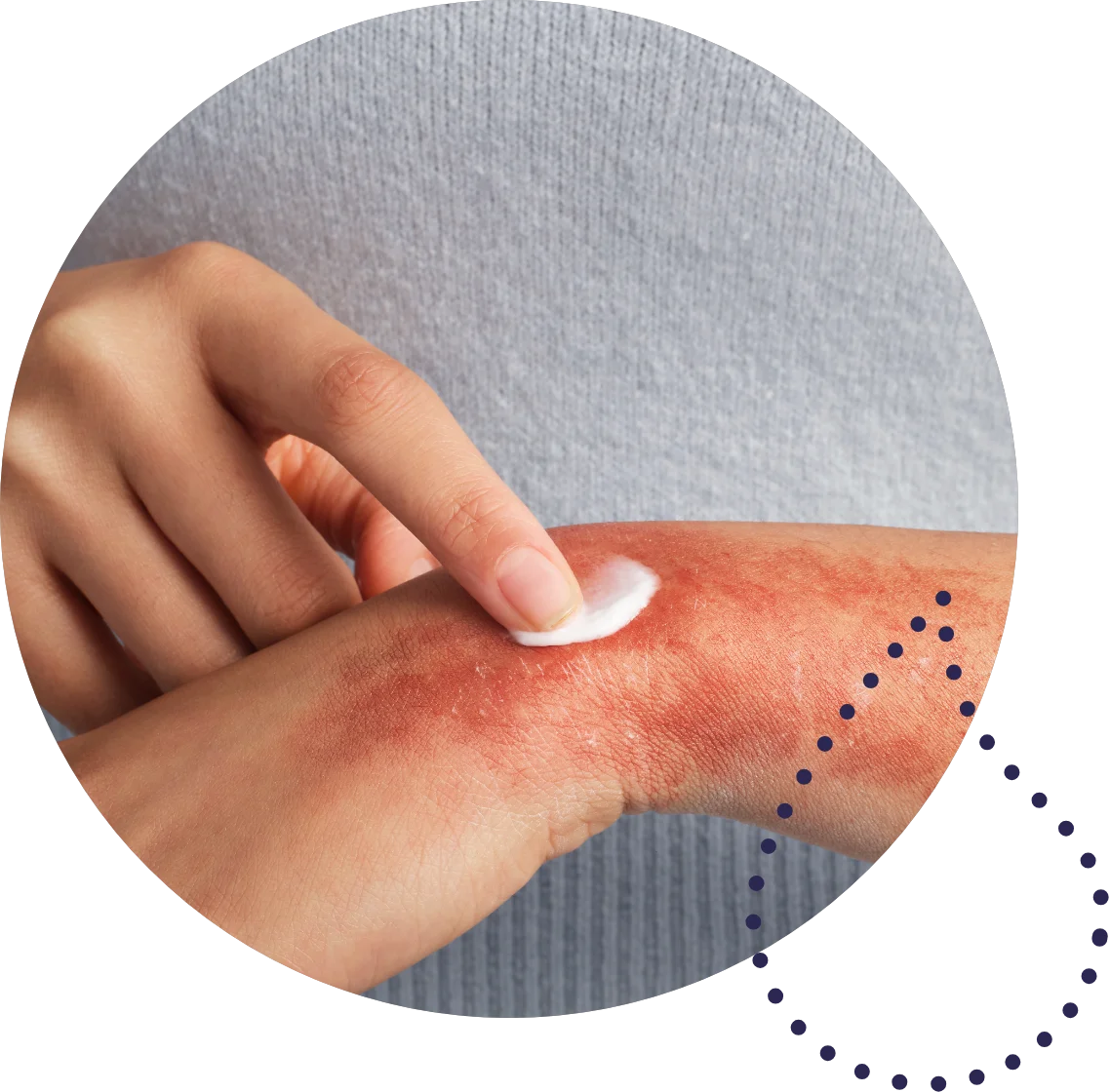 Patient experiencing redness and itching on the wrist