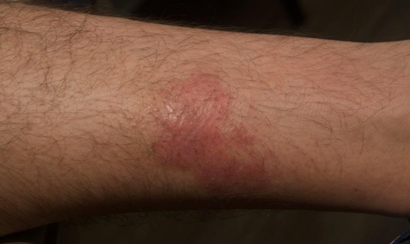 A close up of part of a lower leg showing an atopic dermatitis lesion before treatment that has an IGA score of 3.
