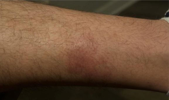 A close up of the same part of a lower leg after 2 weeks of treatment with OPZELURA and a resulting IGA score of 1