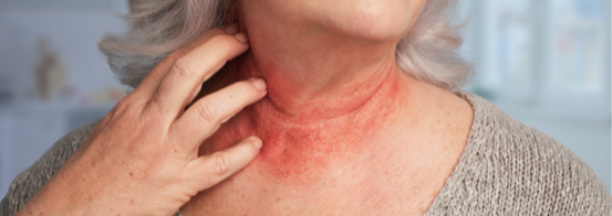 Patient experiencing redness and itching on the neck