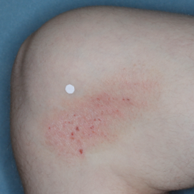 A photo of a patient's knee showing atopic dermatitis before treatment with OPZELURA that has an IGA of 3