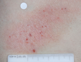 A close-up photo of a patient's knee showing atopic dermatitis before treatment with OPZELURA that has an IGA of 3