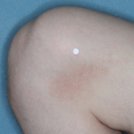 A photo of a patient's knee showing atopic dermatitis after 2 weeks of treatment with OPZELURA and a resulting IGA score of 1