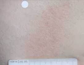 A close-up photo of a patient's knee showing atopic dermatitis after 2 weeks of treatment with OPZELURA and a resulting IGA score of 1