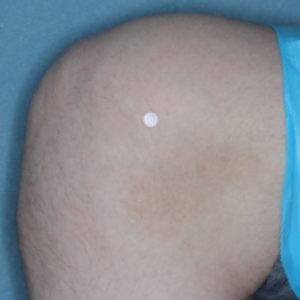 A photo of a patient's knee showing atopic dermatitis after 8 weeks of treatment with OPZELURA and a resulting IGA score of 0