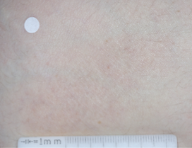 A close-up photo of a patient's knee showing atopic dermatitis after 8 weeks of treatment with OPZELURA and a resulting IGA score of 0