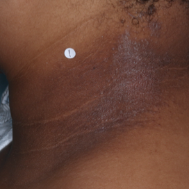 A photo of a patient's neck showing atopic dermatitis before treatment with OPZELURA that has an IGA of 3