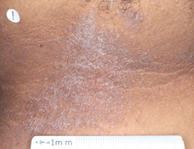 A close-up photo of a patient's neck showing atopic dermatitis before treatment with OPZELURA that has an IGA of 3