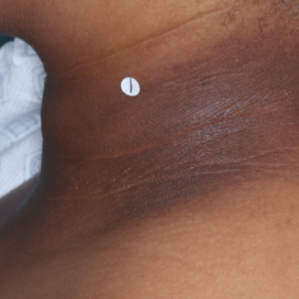 A photo of a patient's neck showing atopic dermatitis after 2 weeks of treatment with OPZELURA and a resulting IGA score of 2