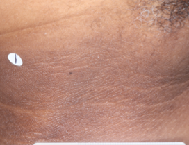 A close-up photo of a patient's neck showing atopic dermatitis after 2 weeks of treatment with OPZELURA and a resulting IGA score of 2