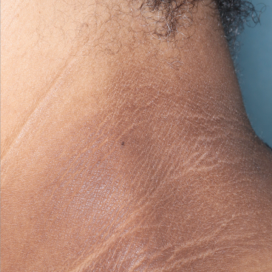 A photo of a patient's neck showing atopic dermatitis after 8 weeks of treatment with OPZELURA and a resulting IGA score of 1