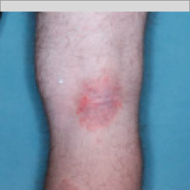 A photo of the back of a patient's knee showing atopic dermatitis before treatment with OPZELURA that has an IGA of 3