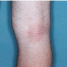 A photo of the back of a patient's knee showing atopic dermatitis after 2 weeks of treatment with OPZELURA and a resulting IGA score of 2