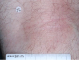 A close-up photo of the back of a patient's knee showing atopic dermatitis after 2 weeks of treatment with OPZELURA and a resulting IGA score of 2