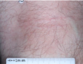 A close-up photo of the back of a patient's knee showing atopic dermatitis after 8 weeks of treatment with OPZELURA and a resulting IGA score of 1