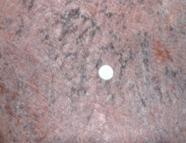 A close-up photo of a patient's calf showing atopic dermatitis before treatment with OPZELURA that has an IGA of 3