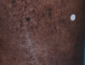 A close-up photo of a patient's calf showing atopic dermatitis after 2 weeks of treatment with OPZELURA and a resulting IGA score of 4