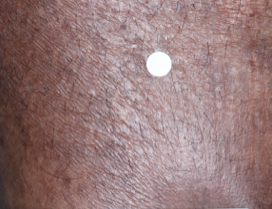 A close-up photo of a patient's calf showing atopic dermatitis after 8 weeks of treatment with OPZELURA and a resulting IGA score of 0