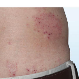 A photo of a patient's back showing atopic dermatitis before treatment with OPZELURA that has an IGA of 3
