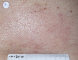A close-up photo of a patient's back showing atopic dermatitis after 2 weeks of treatment with OPZELURA and a resulting IGA score of 1