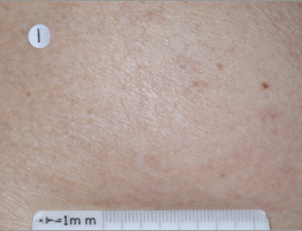 A close-up photo of a patient's back showing atopic dermatitis after 8 weeks of treatment with OPZELURA and a resulting IGA score of 1