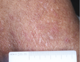 A close-up photo of a patient's neck showing atopic dermatitis before treatment with OPZELURA that has an IGA of 3