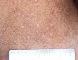 A close-up photo of a patient's neck showing atopic dermatitis after 2 weeks of treatment with OPZELURA and a resulting IGA score of 2