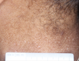 A close-up photo of a patient's neck showing atopic dermatitis after 8 weeks of treatment with OPZELURA and a resulting IGA score of 1