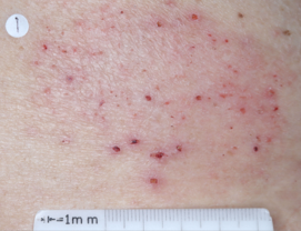 A close-up photo of a patient's back showing atopic dermatitis before treatment with OPZELURA that has an IGA of 3