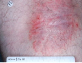 A close-up photo of the back of a patient's knee showing atopic dermatitis before treatment with OPZELURA that has an IGA of 3