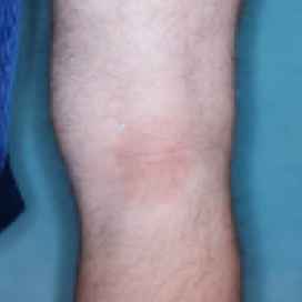 A photo of the back of a patient's knee showing atopic dermatitis after 8 weeks of treatment with OPZELURA and a resulting IGA score of 1
