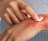 Patient experiencing redness and itching on the hand