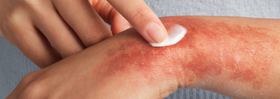 Patient experiencing redness and itching on the hand