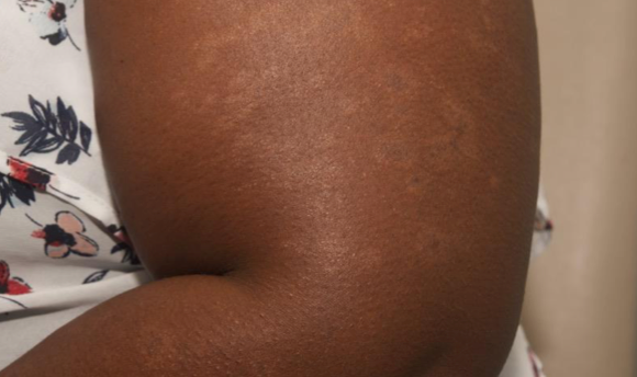 The same arm after 6 weeks of treatment with OPZELURA with a resulting IGA score of 1