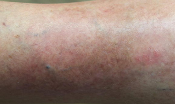 A close-up of the same part of a lower leg after 8 weeks of treatment with OPZELURA and a resulting IGA score of 0