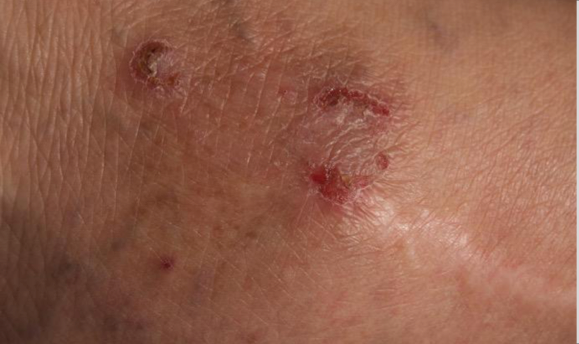A close-up of part of an inner ankle showing an atopic dermatitis lesion before treatment that has an IGA score of 3