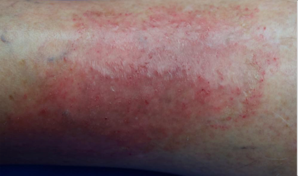 A close-up of part of a lower leg showing an atopic dermatitis lesion before treatment that has an IGA score of 3