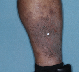 A photo of a patient's calf showing atopic dermatitis before treatment with OPZELURA that has an IGA of 3