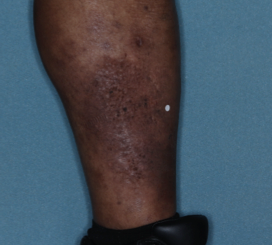 A photo of a patient's calf showing atopic dermatitis after 2 weeks of treatment with OPZELURA and a resulting IGA score of 4