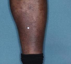 A photo of a patient's calf showing atopic dermatitis after 8 weeks of treatment with OPZELURA and a resulting IGA score of 0