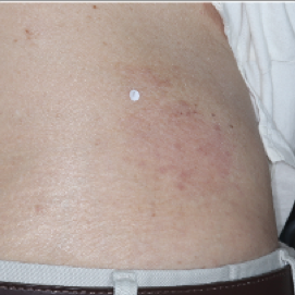 A photo of a patient's back showing atopic dermatitis after 2 weeks of treatment with OPZELURA and a resulting IGA score of 1
